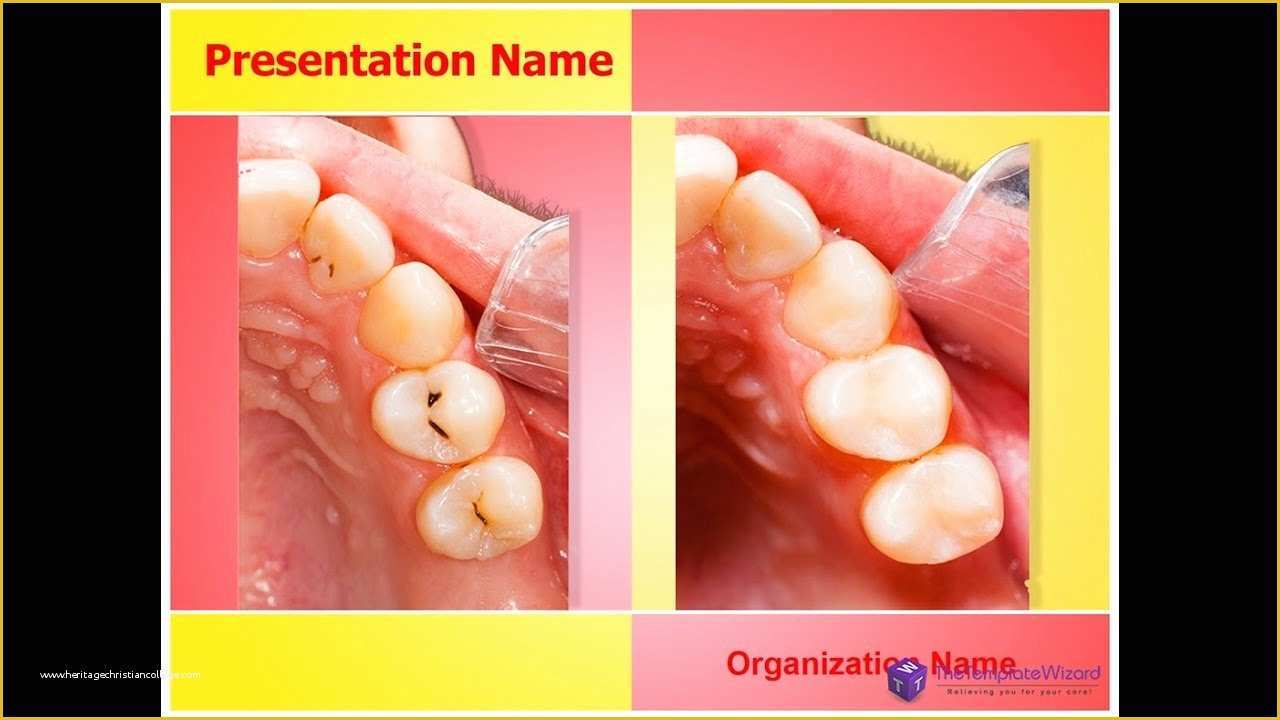 Free Animated Dental Powerpoint Templates Of Dental Posite Teeth Powerpoint Template